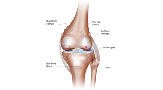 Knee Knee arthritis 2