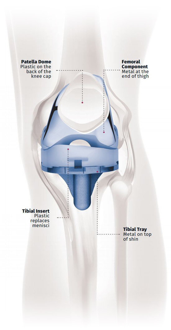 Knee implant